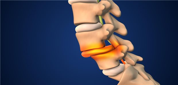 Wirbelsäule mit Spondylolisthesis, aufgrund der sich einzelne Wirbel verlagern.