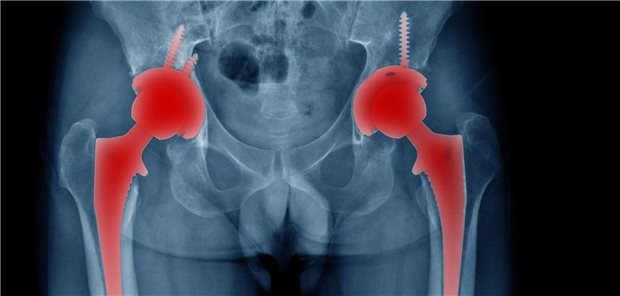 Die Autorinnen und Autoren resümieren, dass die simultan durchgeführte bilaterale Hüft-TEP ein sicheres Vorgehen bei Hüftarthrose im Endstadium zu sein scheint, zumindest für jüngere Patienten und Patientinnen mit begrenzten Komorbiditäten.