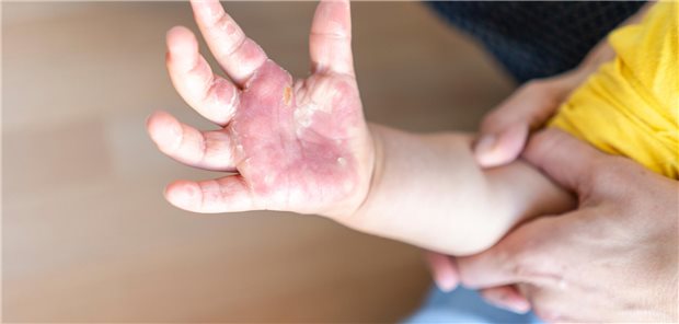 Nahaufnahme der verbrannten Hand eines kleinen Kindes.