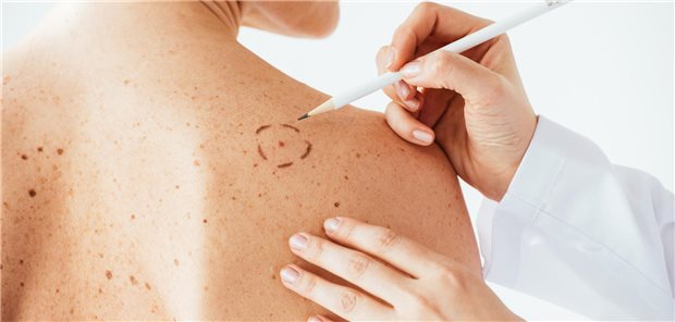 Die Autorinnen und Autoren resümieren, dass ein ATLAS-Symptomscreening eine verbesserte Erkennung von Rezidiven kutaner Melanome bieten kann – ohne, dass ein Risiko durch dieses Vorgehen absehbar wäre.