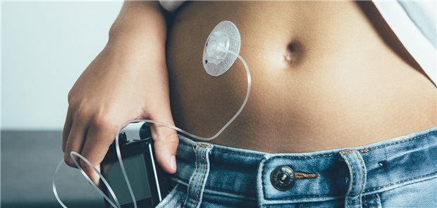 Nahaufnahme eines Kindes mit Typ-1-Diabetes mit einer Insulinpumpe. Die Insulinpumpe ist an seinem Unterleib angeschlossen ist und wird von dem Kind in seiner Hosentasche transportiert.