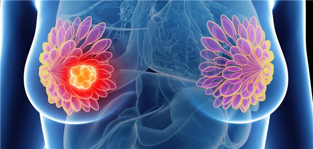Symbolhafte Darstellung eines Mammakarzinoms.