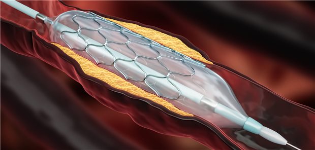 Die Autorinnen und Autoren resümieren, dass für die Überlegenheit der Paclitaxel-Gruppe vor allem der Rückgang der Revaskularisierungen (13 Prozent gegenüber 25 Prozent) und der Herzinfarktraten durch das Zielgefäß (6 Prozent gegenüber 11 Prozent) ausschlaggebend waren.