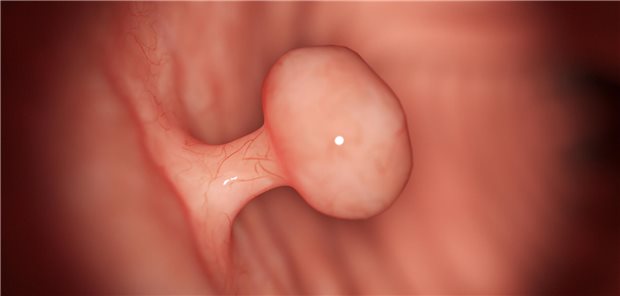 Die Autorinnen und Autoren resümieren, dass letzlich die hohe Rezidivrate die Anwendung der CSP bei größeren ungestielten Darmpolypen, trotz der geringeren Komplikationsrate limitiere. Die CSP sei hier am ehesten eine Option, wenn unter der HSP ein inakzeptables Komplikationsrisiko bestehe, etwa bei entsprechenden Komorbiditäten und einer Antikoagulationstherapie.