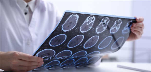 Nahaufnahme wie ein Arzt die MRT-Bilder eines Patienten mit Multipler Sklerose am Tisch in einer Klinik untersucht.
