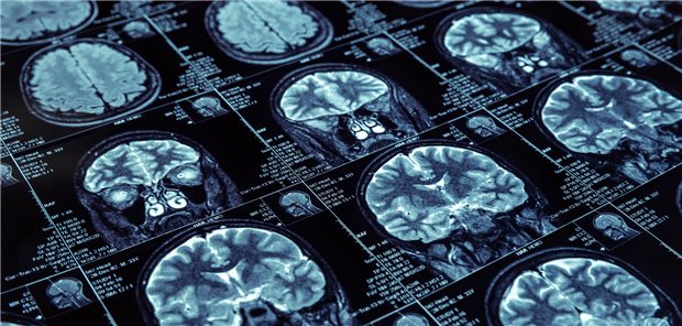 Radiologisch isoliertes Syndrom: Neue Kriterien bewähren sich in der Praxis Die Autorinnen und Autoren resümieren, dass mit den neuen Kriterien die Unterscheidung von Patienten mit und ohne Multiple Sklerose wesentlich besser gelänge: Hier zeigten sich keine Überscheidungen der Konversionskurven. Nach fünf Jahren hatten rund 30 Prozent mit einem RIS nach den neuen Kriterien einen MS-Schub entwickelt, aber nur eine Person (4 Prozent) ohne RIS.