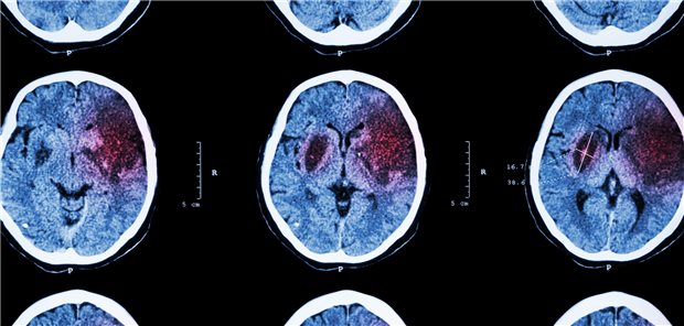 Ischämischer Schlaganfall: CT des Gehirns zeigt Hirninfarkt im Bereich des linken Frontal-,  Temporal- und Parietallappen.