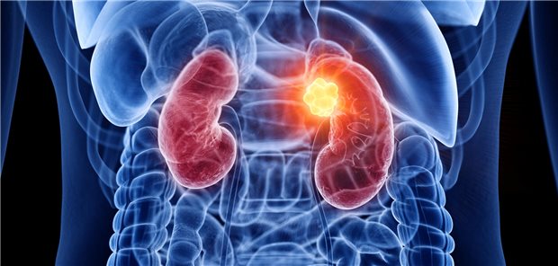 Die Autorinnen und Autoren resümieren, dass sie Ergebnisse der Studie PROSPER EA8143 den Einsatz von perioperativem Nivolumab im Vergleich zur alleinigen Operation nicht stützen.