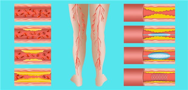 Die Ballondilatation bei schwerer PAVK wurde in der Studie verglichen mit der Versorgung mit einem Scaffold (medikamentenfreisetzendes resorbierbares Gefäßgerüst).