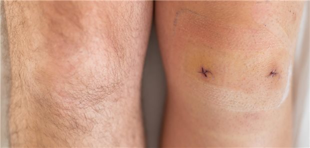 Nahaufnahme des rechten und linken Knie eines Mannes nach einer laparoskopischen Minisk-Operation.