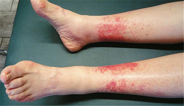 Purpura d'effort - des Läufers rote Beine bei großer Hitze Die Beine einer 71-jährigen nach langen anstrengenden Märschen durch Italiens Städte bei großer Hitze.