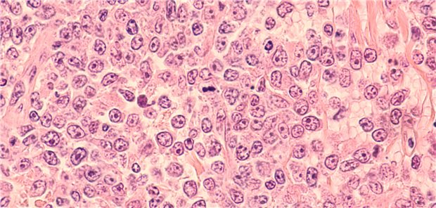 Mikroskopische Aufnahme eines diffusen großzelligen B-Zell-Lymphoms (DLBCL), einer Art von Non-Hodgkin-Lymphom. Dieser Fall stammt aus dem Hoden eines älteren Mannes und zeigt auffällige Nukleoli.