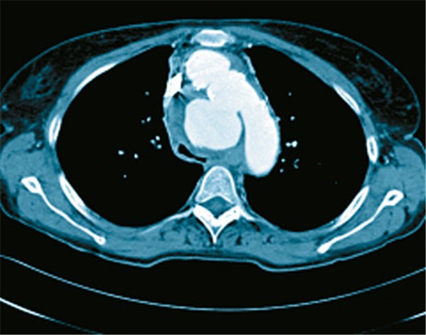 Aortenaneurysma war Ursache von plötzlichen Schluckstörungen Die CT des Thorax offenbarte ein fast fünf Zentimeter großes, teilthrombosiertes sakkuläres Aneurysma verum des Aortenbogens.