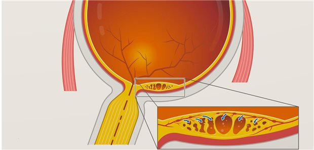 Die Crux mit dem Makulaödem ist, dass es laut Professor Carsten Heinz, vom Augenzentrum des St. Franziskus-Hospital in Münster, irgendwann immer wieder kommt. Er nannte ein Intervall von 2,5-4,5 Monaten. 