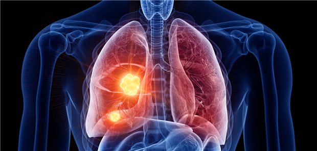 Die DGP hat ihre Empfehlungen zur Versorgung von Patientinnen und Patienten mit Lungenkrebs aktualsiert.
