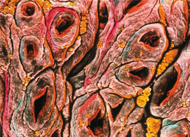 Typ-1-Diabetiker haben erhöhtes Zöliakie-Risiko Die Darmwand bei Zöliakie ist flach und atrophisch - Darmzotten fehlen. © Professors P. M. Motta & F. M. Magliocca / Science Photo Library