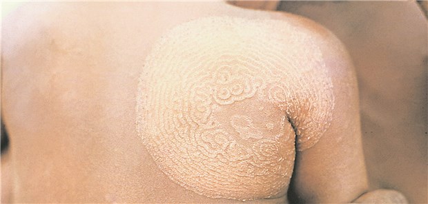Unliebsame Urlaubs-Mitbringsel Die Dermatophytose Tinea imbricata wird durch die Pilzgattung Trichophyton concentricum hervorgerufen.