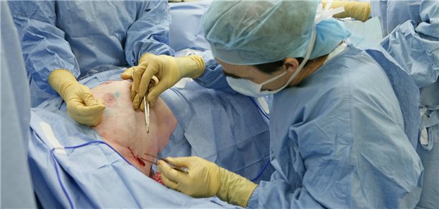 Deutsche Krebshilfe will neue Operationsverfahren fördern Die Deutsche Krebshilfe will die Entwicklung von Operationsverfahren unterstützen, die die Lebensqualität der Patienten erhalten und möglichst wenig Nebenwirkungen mit sich bringen