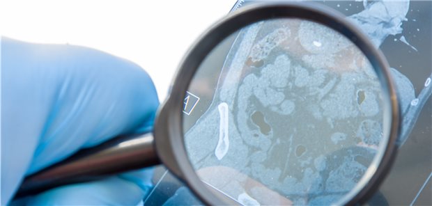 Die Deutschen Gesellschaft für Gastroenterologie, Verdauungs- und Stoffwechselkrankheiten (DGVS) hat genau hingeschaut und die S3-Leitlinie zu Morbus Crohn aktualisiert.