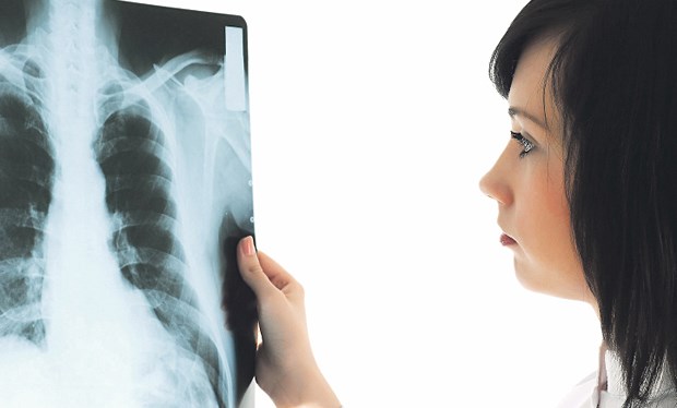 Tuberkulose: Kaum Änderungen bei Standardtherapie Die Differenzierung zwischen einer TB und anderen Lungenerkrankungen ist nicht immer leicht.