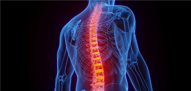 Dreidimensionale gerenderte medizinische Illustration der aufgrund einer Difficult-to-Manage (D2M) Spondyloarthritis (SpA) entzündeten Wirbelsäule bei einem männlichen Patienten.