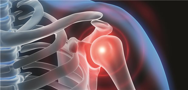 Die Diskussionen um das Krankheitsbild der Frozen Shoulder sind noch nicht beendet: Was spielt sich bei Betroffenen ums Gelenk herum ab, welche Therapie ist die optimale?