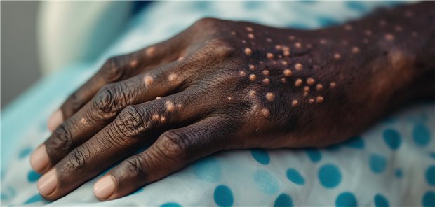 Hand mit Mpox-Merkmalen