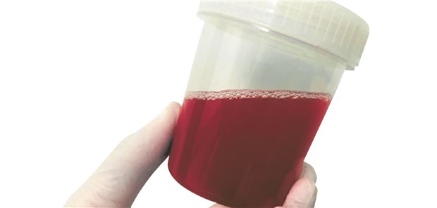 Die Einnahme von Antikoagulantien oder Thrombozytenaggregationshemmern ist ein bekannter Risikofaktor für die Entstehung einer spülpflichtigen Makrohämaturie.