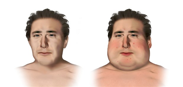 Weniger Steroid-Nebenwirkungen mit Metformin? Die Entwicklung eines Cushing Syndroms mit Mondgesicht und Akne (rechts) ist eine häufige Nebenwirkung der Steroid-Langzeittherapie.