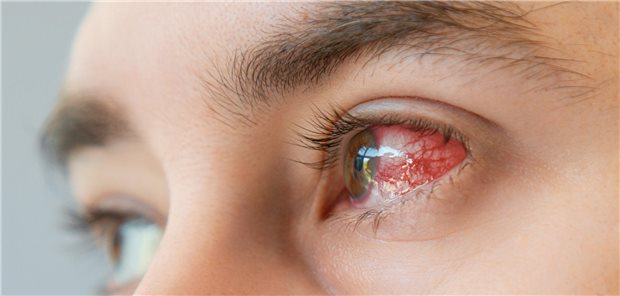 Rotes Auge aufgrund einer infektiösen Hornhautentzündung.