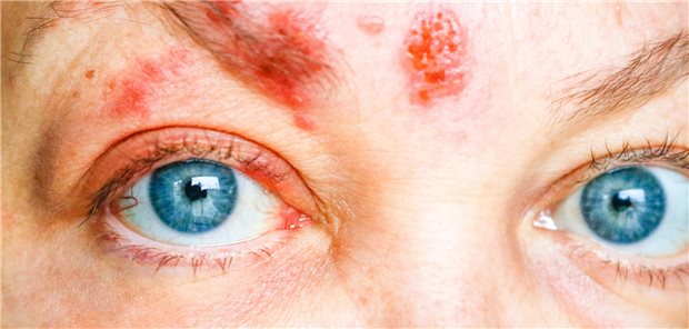 Die Ergebnisse einer US-Amerikanischen Real-World-Studie unterstreichen den Stellenwert der vollständigen Impfung gegen Herpes zoster ab 50 Jahren, auch zum Schutz der Augen.