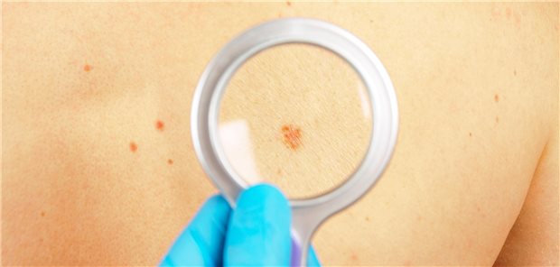 Ein Dermatologe führt eine Hautuntersuchung durch, dabei untersucht er Muttermale und Hautgebilde zur Diagnose und Beurteilung des Hautzustandes.