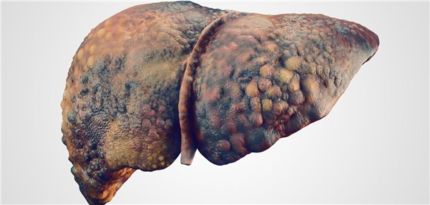 Die Ergebnisse von den Studien mit zwei verschiedenen Twinkretinen können belegen, dass diese einen positiven Effekt auf eine mit metabolischer Dysfunktion assoziierte Steatohepatitis (MASH) mit Fibrose aufweisen. 