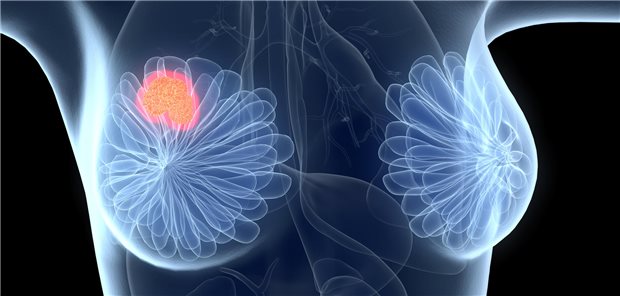 Die Erkenntnisse des Projekts DIMASOS 2 können dazu beitragen, die Früherkennung von Brustkrebs bei Frauen mit sehr dichtem Drüsengewebe zu verbessern.