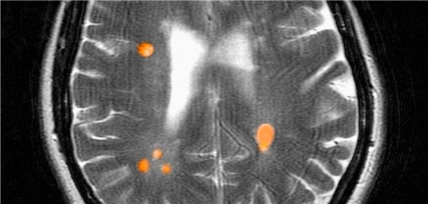 Die Erkrankung im Blick: Multiple Sklerose in der Magnetresonanzangiografie bei einer 42-jährigen Frau.