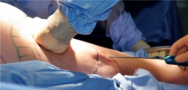 Die Fettabsaugung ist in schweren Lipödem-Fällen nun Kassenleistung.