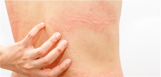 Die Forschenden resümieren als Ergebnis ihres systematischen Reviews, dass da die Ergebnisse der veröffentlichten Studien widersprüchlich sind, der Zusatz von Kortikosteroiden zu einem Antihistaminikum als Behandlungsoption für akute Urtikaria weiter untersucht werden muss. Anhand der derzeit verfügbaren Daten lasse sich die Frage nicht beantworten.