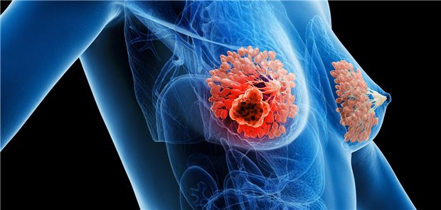 Die Forschenden um Dr. Hanbing Guo resümieren, dass die Ergebnisse nahe legen, dass die Einnahme von Statinen nach einer Brustkrebsdiagnose mit einem verbesserten krebsspezifischen Überleben einhergeht. 