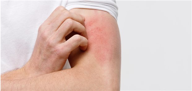 Die Forschenden um Jie Zhu resümieren, dass sich Ärztinnen und Ärzte darüber im Klaren sein, dass neben der Phototherapie neue physikalische Behandlungsmöglichkeiten, wie Lasertherapien, zur Behandlung von Patientinnen und Patienten mit Pruritus im Kommen sind.