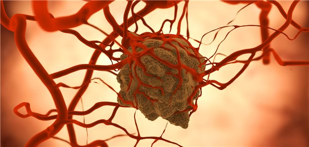 Die Forschenden um Li sehen in den Ergebnissen klare Hinweise, dass viele Personen mit HER2-aktivierenden Tumoren, für die bislang keine zielgerichteten Therapien zugelassen sind, von der Behandlung mit Trastuzumab deruxtecan (T-DXd) profitieren. Letztlich sind nun aber größere kontrollierte Studien nötig, um genauer zu schauen, wem die Behandlung am ehesten nützt. 