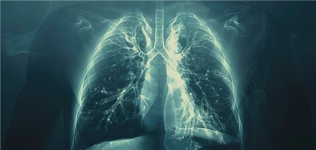 Die Forscher und Forscherinnen resümieren, dass bei Patienten mit Antikörpern assoziierten Vaskulitiden (AAV) ILD-Prävalenzraten von bis zu 23 Prozent bei Granulomatose mit Polyangiitis und bis zu 45 Prozent bei mikroskopischer Polyangiitis berichtet wurden. Daher könnte ein positives Ergebnis die klinische Überwachung auf andere Anzeichen einer AAV und eine Überweisung zu einem Vaskulitis-Experten rechtfertigen.