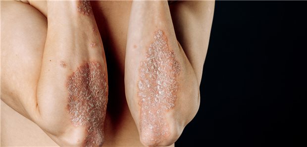 Die Forscher und Forscherinnen resümieren, dass die Psoriasisarthritis eine heterogene Erkrankung ist, und sich deshalb die Wahl der Behandlung nach individuellen Patientenmerkmalen, der Wirksamkeit gegen das breite Spektrum von Haut- und Gelenksymptomen sowie den unterschiedlichen Kontraindikationen für bestimmte Behandlungen richtet.