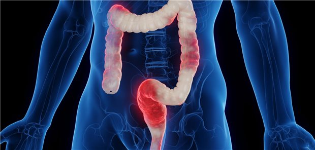 Die Forschungsgruppe um Fai Fai Ho konstatiert, dass davon ausgegangen werden kann, dass die Einhaltung einer größeren Anzahl gesunder Lebensgewohnheiten in der Allgemeinbevölkerung signifikant mit einer geringeren Inzidenz des RDS verbunden ist. Die Ergebnisse ihrer Studie unterstrichen das Potenzial von Änderungen des Lebensstils als Strategie zur Primärprävention von RDS.