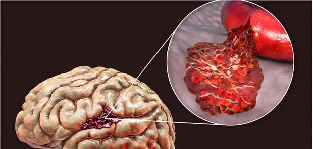 Die Forschungsgruppe um Sylvain Bétrisey und Moa Lina Haller vom Inselspital Bern resümiert, dass unter Statinen die Number Needed to Harm mit 3.333 pro 6,7 Jahre sehr viel niedriger als die Number Needed to Prevent ist. Das Risiko für hämorrhagische Schlaganfälle (HS) sei daher aus ihrer Sicht kein Grund, auf den Nutzen einer Statintherapie zu verzichten.