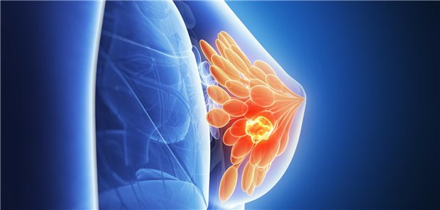 Computergebaute Grafik des Brustgewebes und eines Tumors.