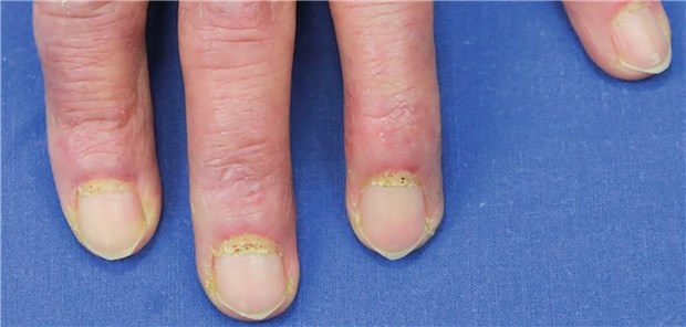 Die Gottron-Papeln, livide Erhabenheiten (Papeln/Plaques) an den Fingerstreckseiten, sind pathognomonische Zeichen der Dermatomyositis. Außerdem sind Teleangiektasien, zum Teil mit Splitterblutungen im Bereich des Nagelfalzes, und die Verdickung der Nagelhaut (sog. Keining-Zeichen) typisch.