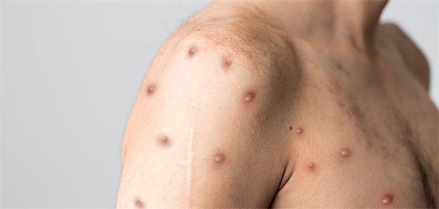 MPOX-Läsionen bei einem Mann.