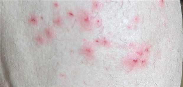 Affenpocken jenseits von Afrika: anogenitale Läsionen besonders häufig Die Hautläsionen bei einer Affenpocken-Infektion können an verschiedenen Körperstellen auftreten. Ein Studie zeigt, dass sie bei Fällen in nicht-afrikanischen Ländern insbesondere im Anal- und Genitalbereich zu finden sind.