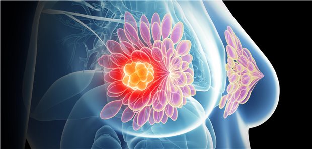 Dreidimensionale gerenderte medizinisch Illustration einer Frau mit einem Tumor in der rechten Brust.