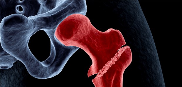 Die Hüftfraktur-Rate lag bei Frauen mit einem frakturbegünstigenden Medikament bei 6,5 pro 1000 Personenjahre.